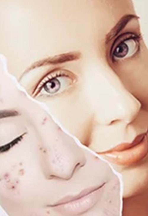 Chemical-Peels