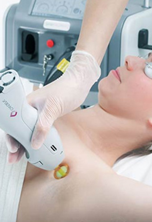 Laser-Hair-Removal
